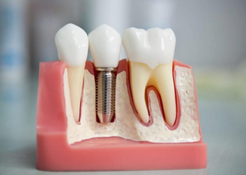 Особенности и основные правила протезирования зубов