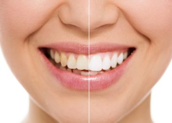 Отбеливание зубов: достоинства и этапы процедуры