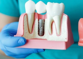 Основные разновидности зубных имплантов и этапы установки