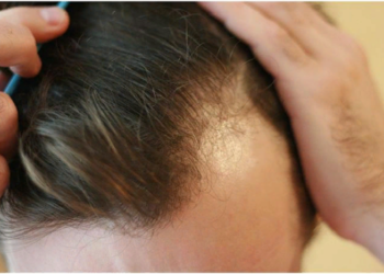 Залысины: причины появления и как это устранить