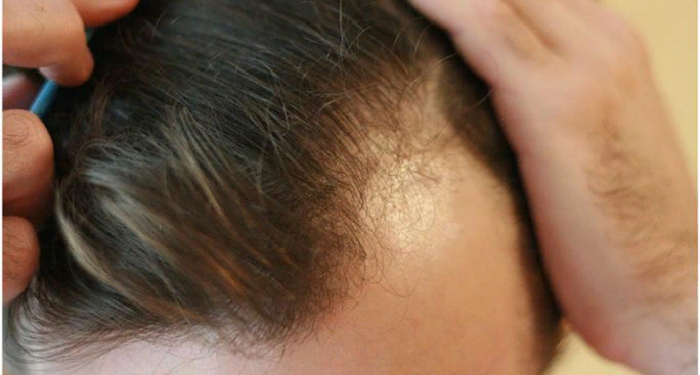 Залысины: причины появления и как это устранить