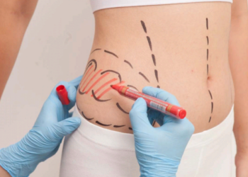 Лазерная липосакция: достоинства и правила