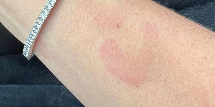 Откуда появились пятна на теле Анны Седоковой