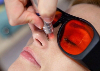 Технология удаления сосудистой сетки лазером