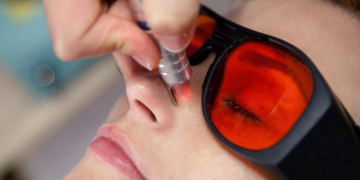 Технология удаления сосудистой сетки лазером