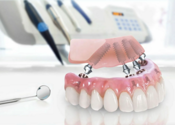 Имплантация All-on-4: достоинства и правила