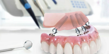 Имплантация All-on-4: достоинства и правила