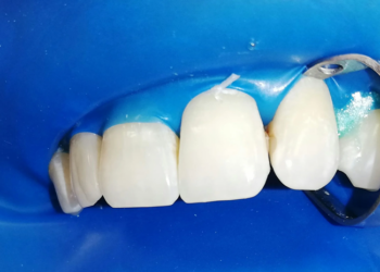 Технология выполнения реставрации зубов у профессионалов