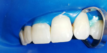 Технология выполнения реставрации зубов у профессионалов