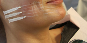 Лифтинг через регенерацию тканей с Luxeface & Luxebody