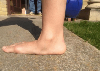 Плоскостопие и его последствия для организма человека