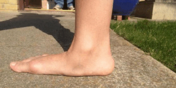 Плоскостопие и его последствия для организма человека