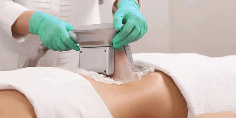 Криолиполиз: безопасное и эффективное решение для коррекции фигуры