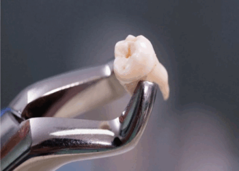 Как безболезненно и быстро удалить зубы: варианты и советы