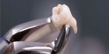 Как безболезненно и быстро удалить зубы: варианты и советы