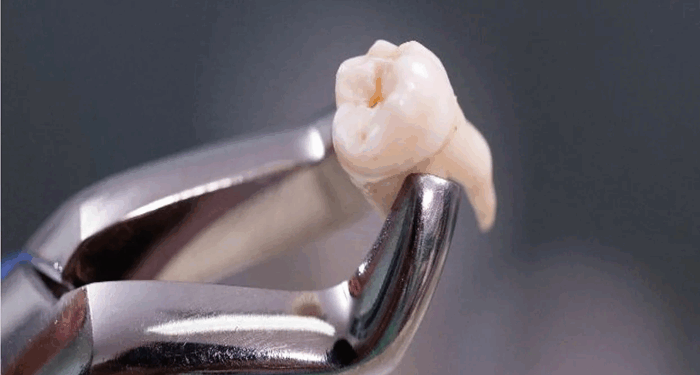 Как безболезненно и быстро удалить зубы: варианты и советы