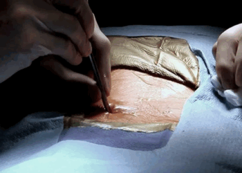 Как следует выполнять вшивание торпеды: правила и советы