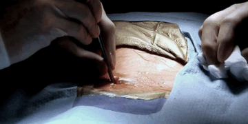 Как следует выполнять вшивание торпеды: правила и советы