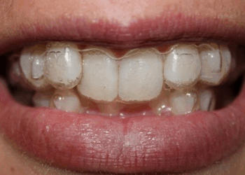 Элайнеры: понятие, достоинства и установка