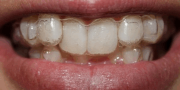 Элайнеры: понятие, достоинства и установка