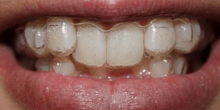 Элайнеры: понятие, достоинства и установка