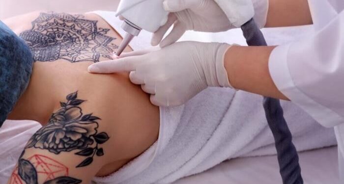 Преимущества лазерного удаления тату и правила безопасного проведения процедуры