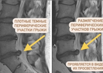 Почему боль может пройти раньше, чем исчезнет грыжа после резорбции