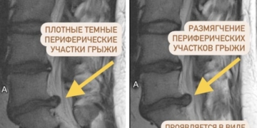 Почему боль может пройти раньше, чем исчезнет грыжа после резорбции