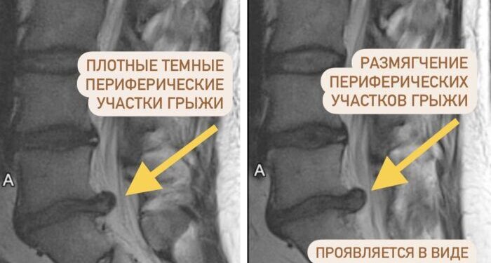 Почему боль может пройти раньше, чем исчезнет грыжа после резорбции